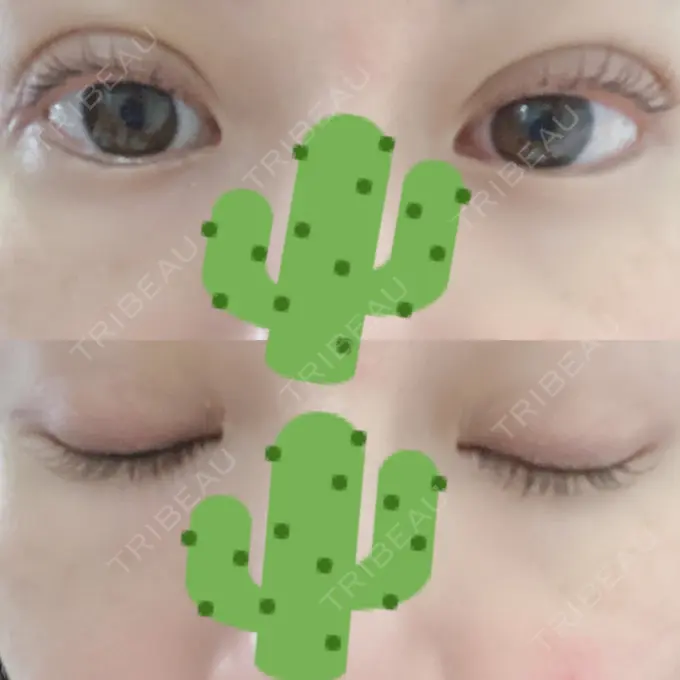 二重埋没 湘南美容クリニック 熊本院 AFTER メイン用