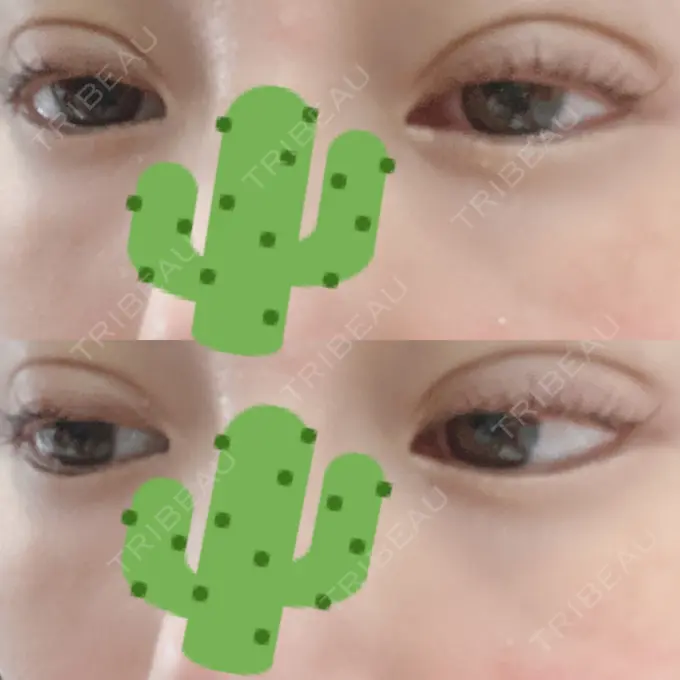 二重埋没 湘南美容クリニック 熊本院 DAY 4 メイン用