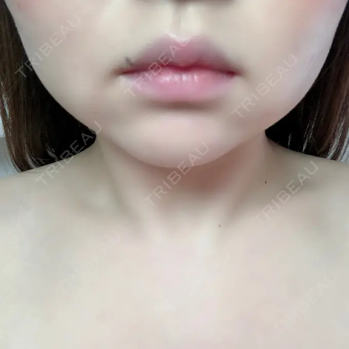 脂肪溶解注射（顔） 赤坂プレミアクリニック DAY 9 メイン用