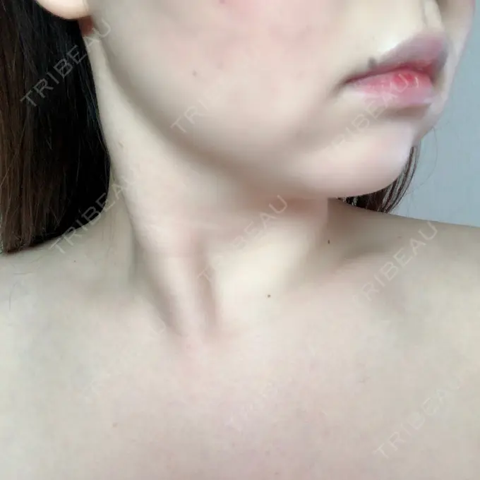 脂肪溶解注射（顔） 赤坂プレミアクリニック DAY 9 メイン用