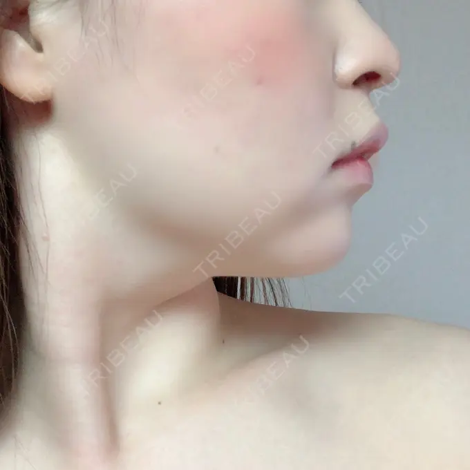 脂肪溶解注射（顔） 赤坂プレミアクリニック DAY 9 メイン用