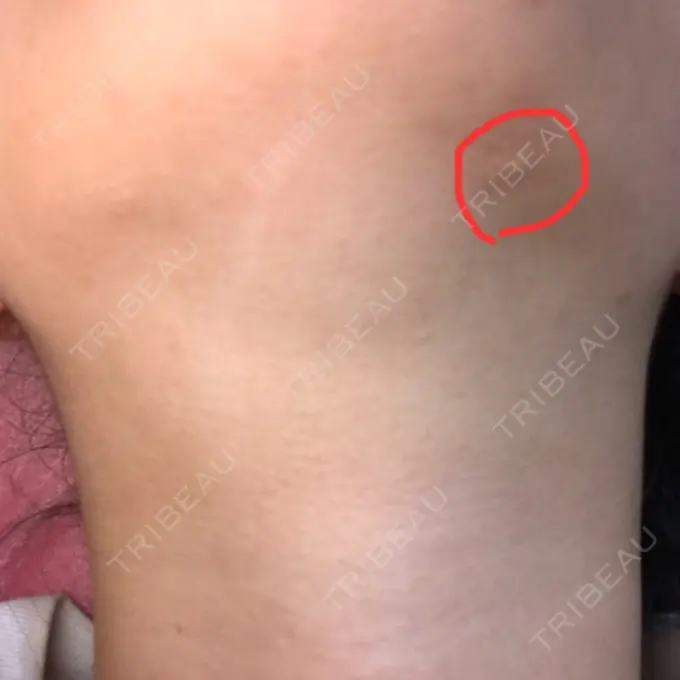 脂肪吸引（顔） みずほクリニック DAY 373 メイン用