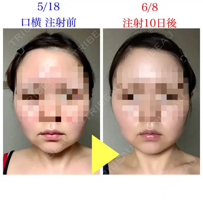 脂肪溶解注射（顔） 赤坂プレミアクリニック DAY 10 メイン用