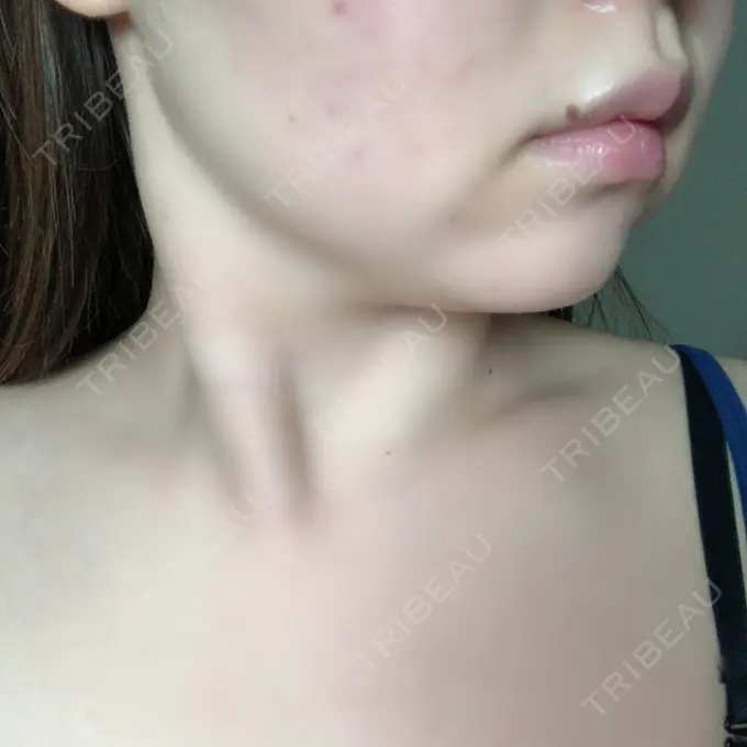 脂肪溶解注射（顔） 赤坂プレミアクリニック DAY 10 メイン用