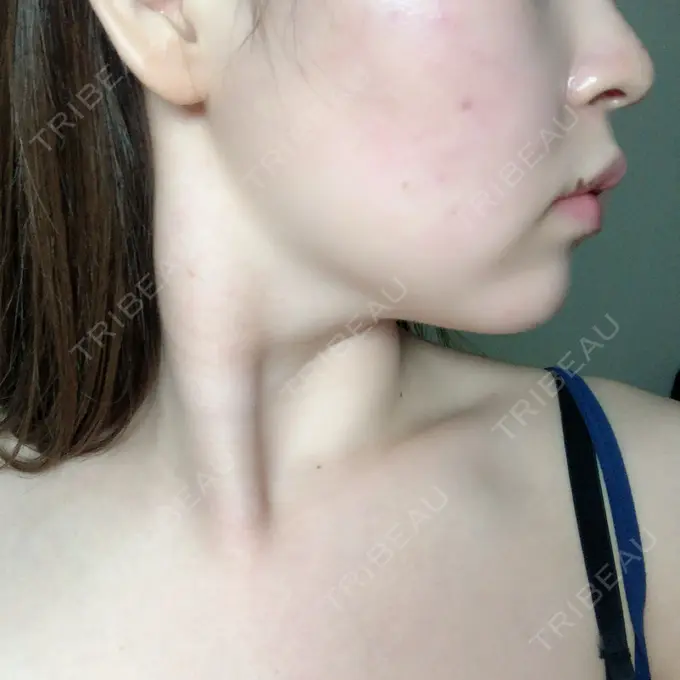 脂肪溶解注射（顔） 赤坂プレミアクリニック DAY 10 メイン用