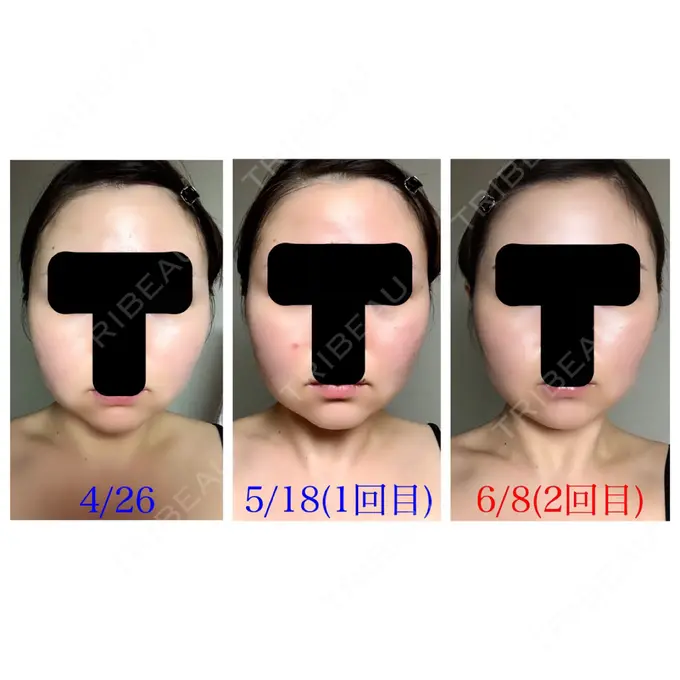 脂肪溶解注射（顔） 赤坂プレミアクリニック AFTER メイン用