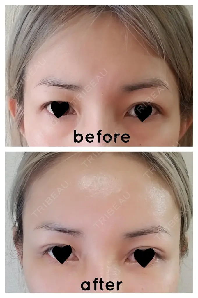 二重埋没 / 糸リフト / クマ治療 / 額を丸く / 下まぶたたるみ取り / 下まぶたの脂肪取り / 脂肪注入（額） / 脂肪注入（輪郭） 湘南美容クリニック 自由が丘院 DAY 15 メイン用