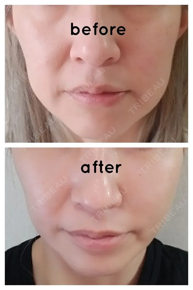 二重埋没 / 糸リフト / クマ治療 / 額を丸く / 下まぶたたるみ取り / 下まぶたの脂肪取り / 脂肪注入（額） / 脂肪注入（輪郭） 湘南美容クリニック 自由が丘院 DAY 15 メイン用