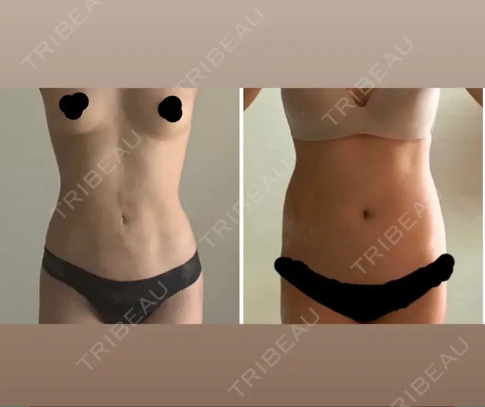 脂肪吸引（お腹） WOM CLINIC GINZA （ワム クリニック ギンザ） DAY 42 メイン用