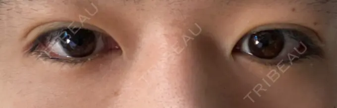 二重埋没 城本クリニック 福岡院 DAY 4 メイン用