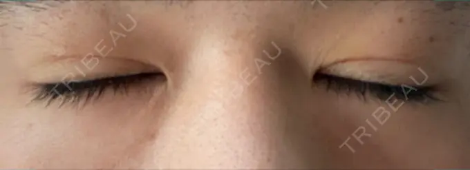 二重埋没 城本クリニック 福岡院 DAY 4 メイン用