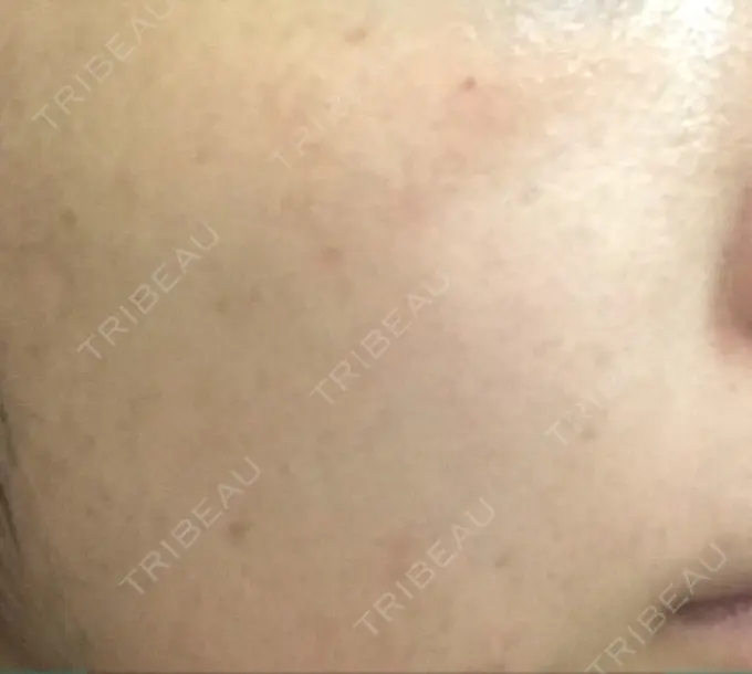 ほくろ・いぼ切除（肌） / ほくろ・いぼ除去レーザー（肌） / 美白レーザー / YAGレーザー REYOUNGクリニック DAY 13 メイン用