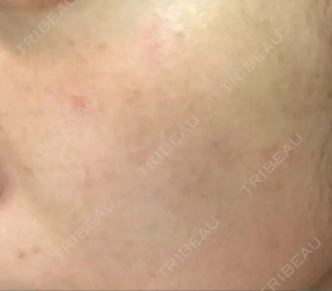 ほくろ・いぼ切除（肌） / ほくろ・いぼ除去レーザー（肌） / 美白レーザー / YAGレーザー REYOUNGクリニック DAY 13 メイン用