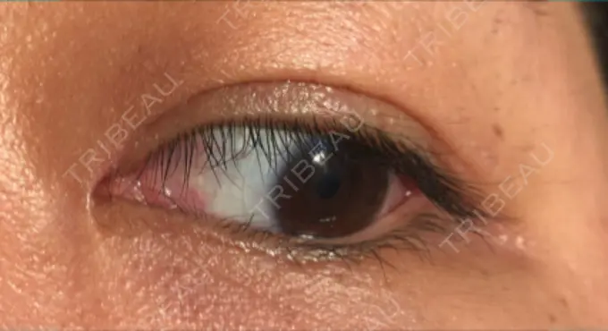 二重切開 / 目頭切開 / その他（目元） 新前橋かしま眼科形成外科クリニック AFTER メイン用