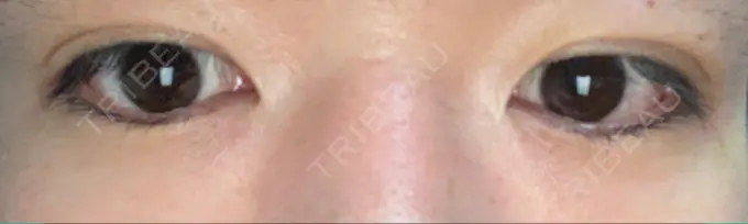 二重埋没 城本クリニック 福岡院 DAY 5 メイン用