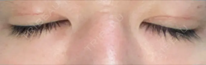 二重埋没 城本クリニック 福岡院 DAY 5 メイン用