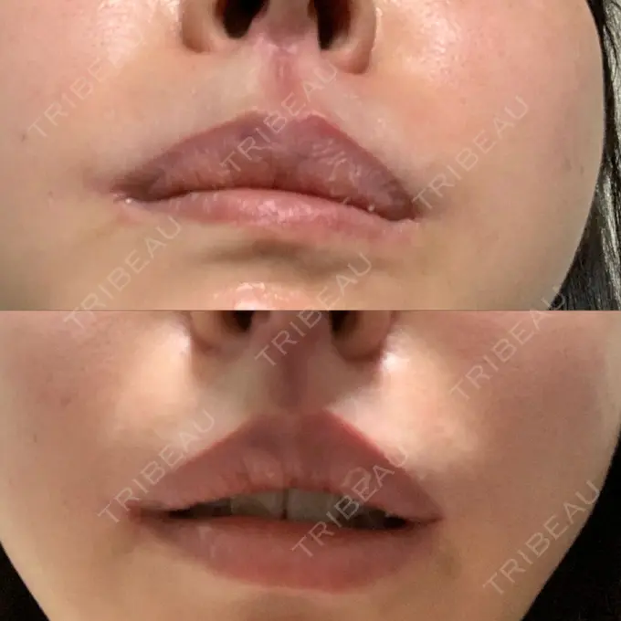 ヒアルロン酸溶解 / その他（口元） 六本木スキンクリニック DAY 2 メイン用