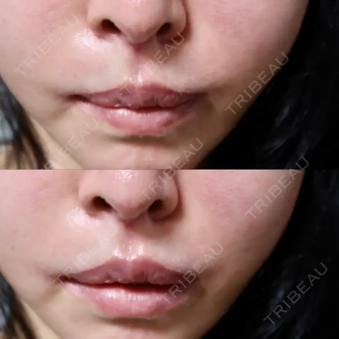 ヒアルロン酸溶解 / その他（口元） 六本木スキンクリニック DAY 2 メイン用