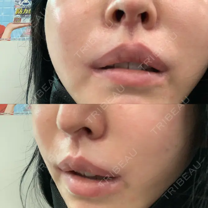 ヒアルロン酸溶解 / その他（口元） 六本木スキンクリニック DAY 4 メイン用