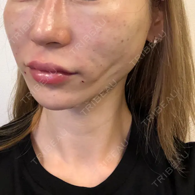 糸リフト / 肌ヒアルロン酸注入（たるみ・シワ改善） / ボトックス（エラ・小顔） 大阪TAクリニック DAY 0 メイン用