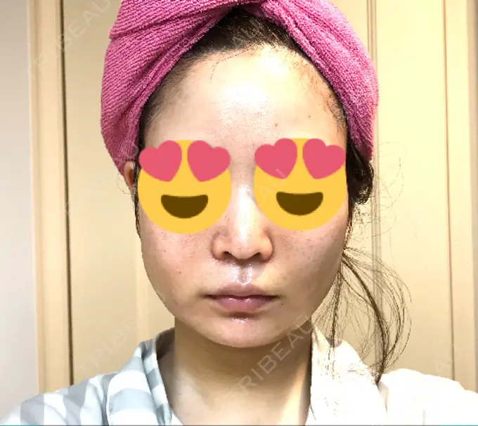 脂肪吸引（顔） / メーラーファット除去 湘南美容クリニック 秋葉原院 DAY 1 メイン用