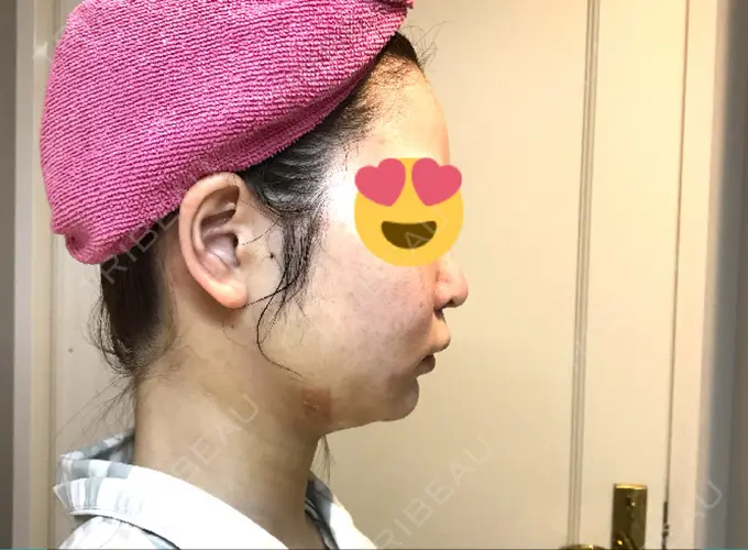 脂肪吸引（顔） / メーラーファット除去 湘南美容クリニック 秋葉原院 DAY 1 メイン用