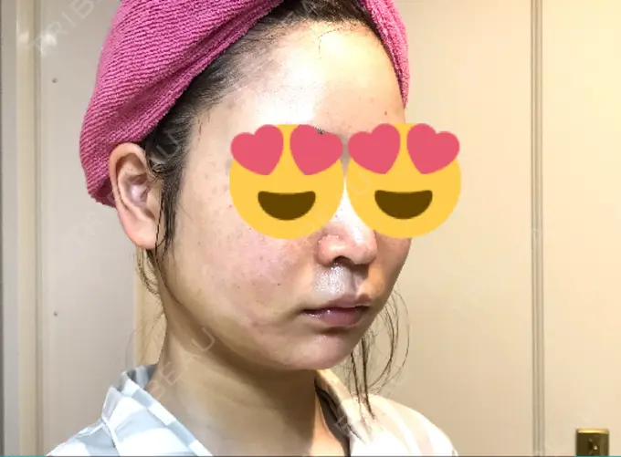 脂肪吸引（顔） / メーラーファット除去 湘南美容クリニック 秋葉原院 DAY 1 メイン用