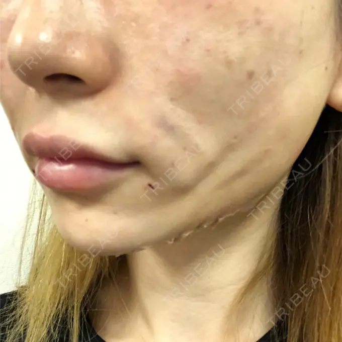 糸リフト / 肌ヒアルロン酸注入（たるみ・シワ改善） / ボトックス（エラ・小顔） 大阪TAクリニック DAY 0 メイン用