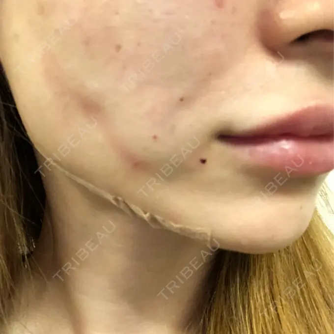 糸リフト / 肌ヒアルロン酸注入（たるみ・シワ改善） / ボトックス（エラ・小顔） 大阪TAクリニック DAY 0 メイン用