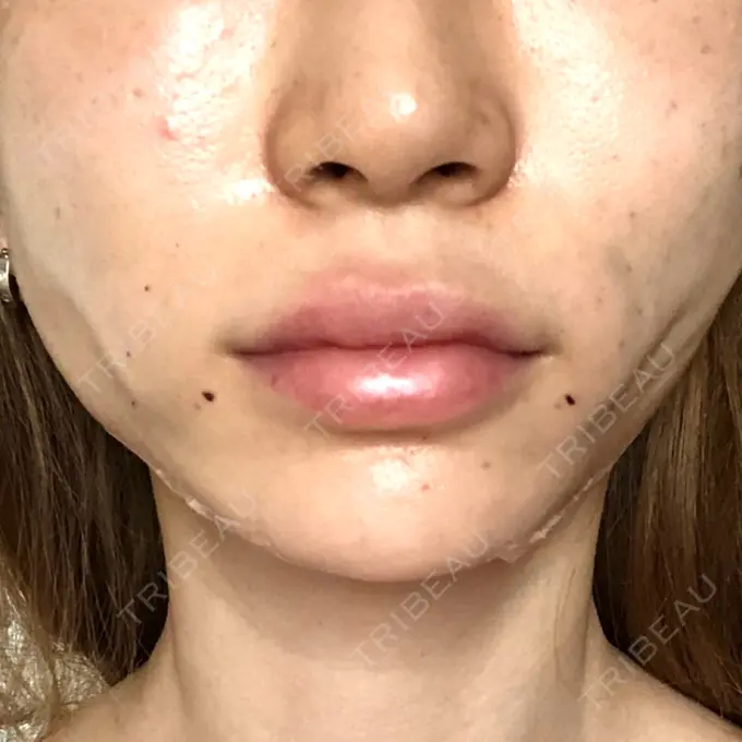 糸リフト / 肌ヒアルロン酸注入（たるみ・シワ改善） / ボトックス（エラ・小顔） 大阪TAクリニック DAY 1 メイン用