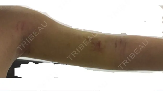 脂肪吸引（二の腕） / インディバ（お腹） ヨンセスリムライン DAY 11 メイン用