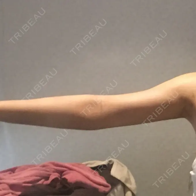 脂肪吸引（二の腕） / インディバ（お腹） ヨンセスリムライン DAY 20 メイン用