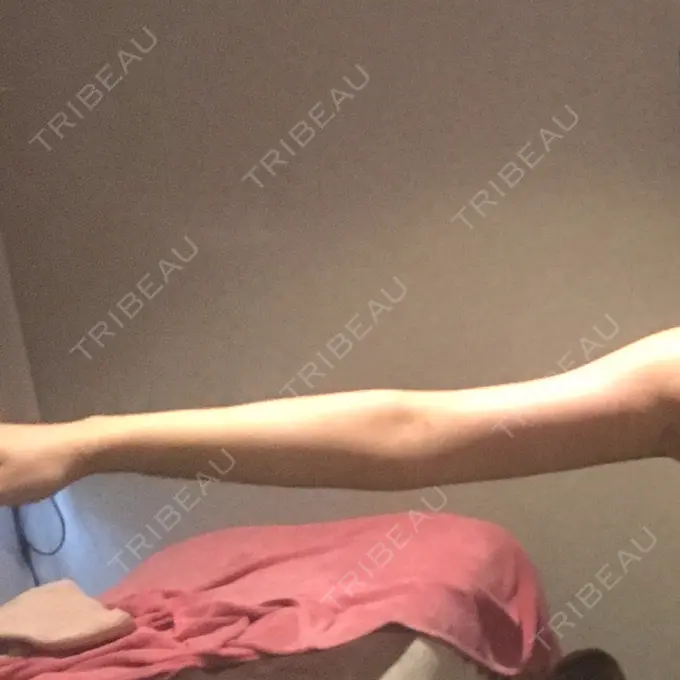 脂肪吸引（二の腕） / インディバ（お腹） ヨンセスリムライン DAY 29 メイン用