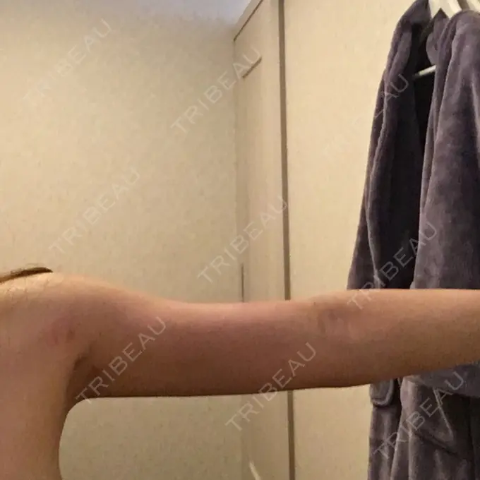 脂肪吸引（二の腕） / インディバ（お腹） ヨンセスリムライン DAY 36 メイン用