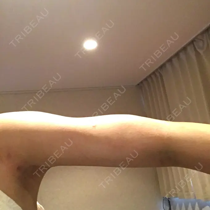 脂肪吸引（二の腕） / インディバ（お腹） ヨンセスリムライン DAY 41 メイン用