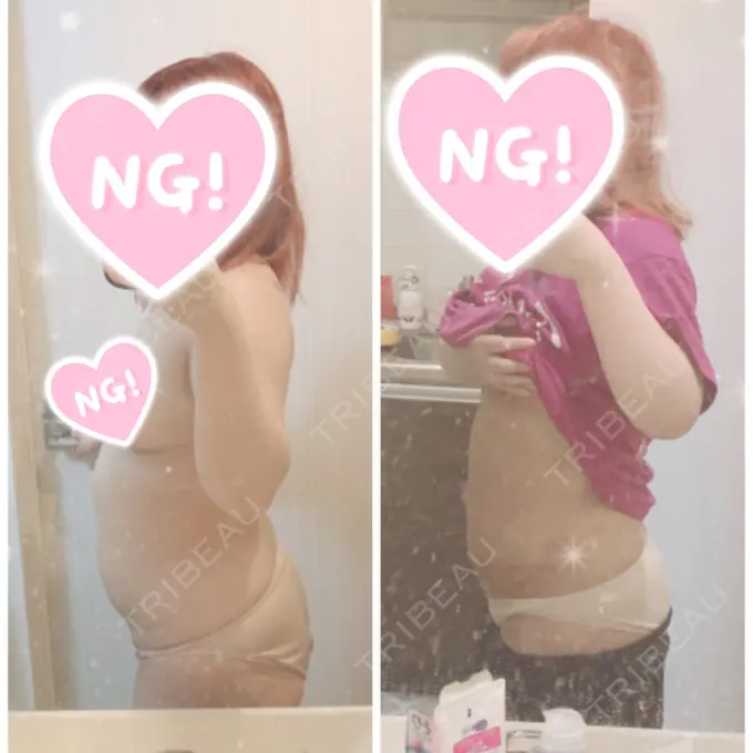 脂肪吸引（二の腕） / 脂肪吸引（お腹） 湘南美容クリニック 新橋銀座口院 AFTER メイン用