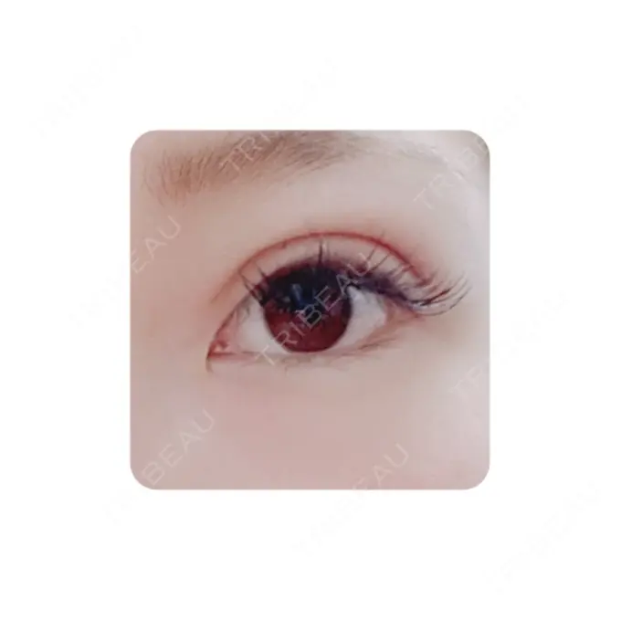 二重切開 カリスクリニック DAY 33 メイン用