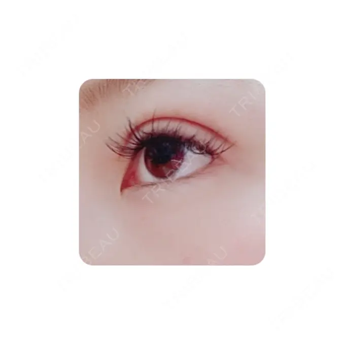 二重切開 カリスクリニック DAY 33 メイン用