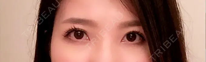 眼瞼下垂（切開） あきこクリニック DAY 62 メイン用