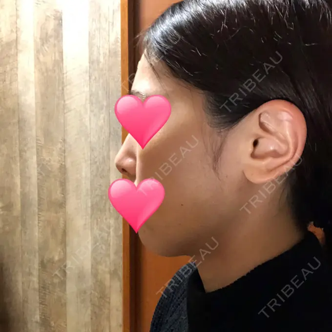 ほくろ・いぼ切除（肌） / バッカルファット除去 / 脂肪吸引（顔） / ヒアルロン酸注入（あご） エートップ美容整形外科 DAY 12 メイン用