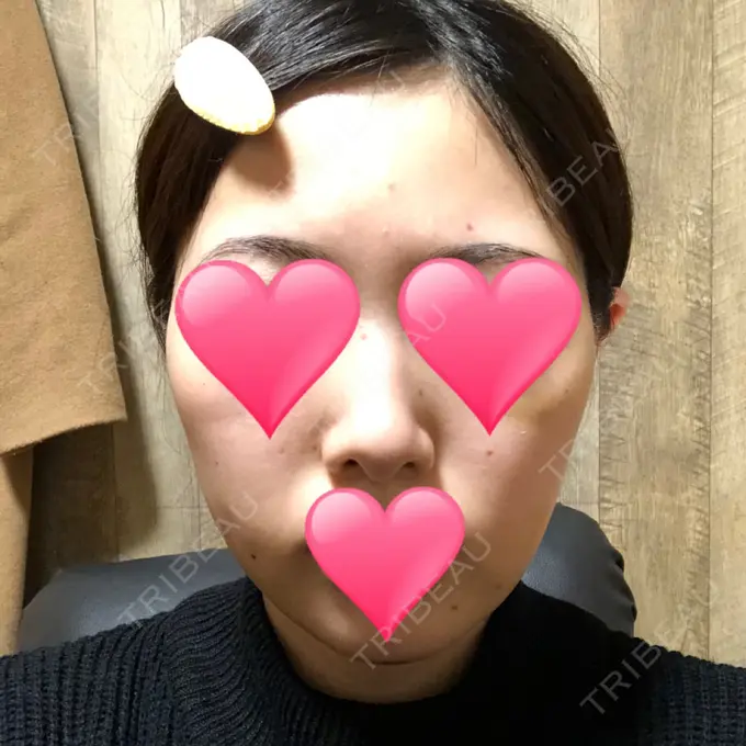 ほくろ・いぼ切除（肌） / バッカルファット除去 / 脂肪吸引（顔） / ヒアルロン酸注入（あご） エートップ美容整形外科 DAY 12 メイン用