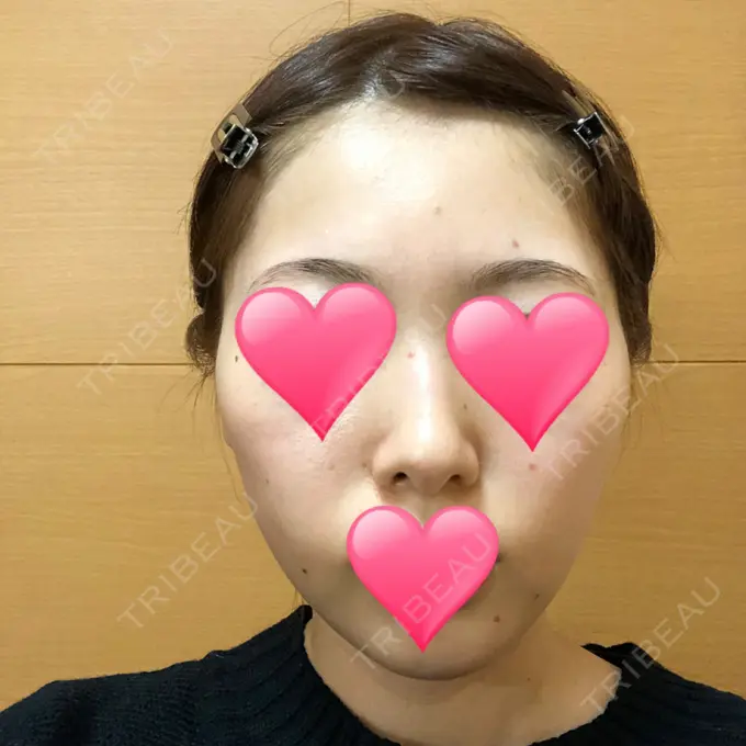 ほくろ・いぼ切除（肌） / バッカルファット除去 / 脂肪吸引（顔） / ヒアルロン酸注入（あご） エートップ美容整形外科 DAY 24 メイン用