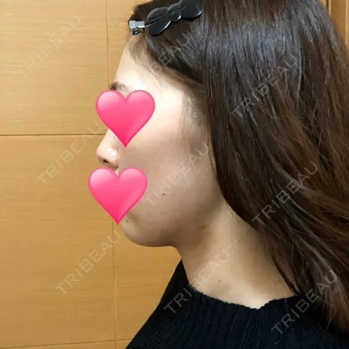 ほくろ・いぼ切除（肌） / バッカルファット除去 / 脂肪吸引（顔） / ヒアルロン酸注入（あご） エートップ美容整形外科 DAY 24 メイン用