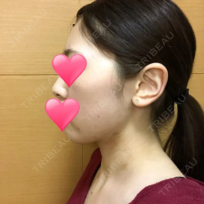 ほくろ・いぼ切除（肌） / バッカルファット除去 / 脂肪吸引（顔） / ヒアルロン酸注入（あご） エートップ美容整形外科 DAY 31 メイン用