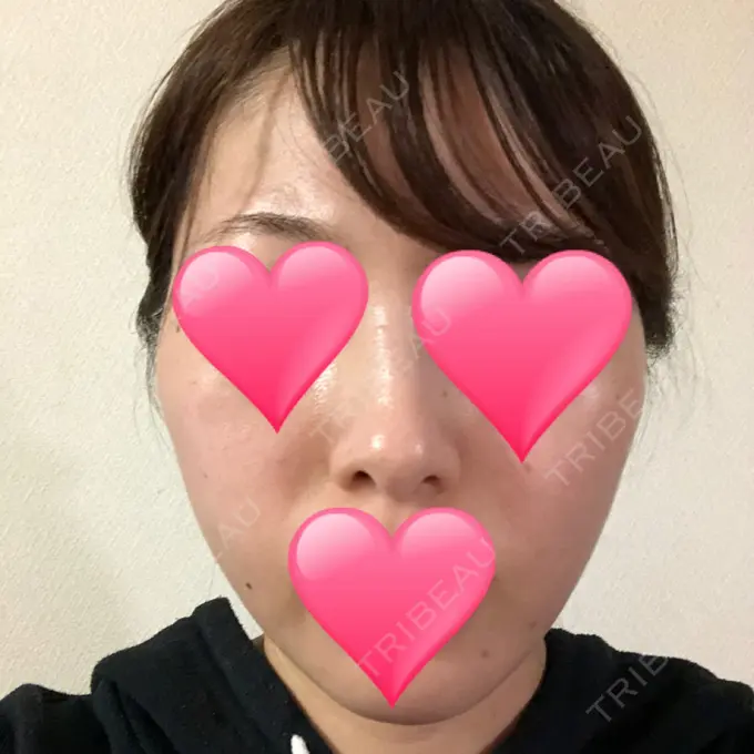 ほくろ・いぼ切除（肌） / バッカルファット除去 / 脂肪吸引（顔） / ヒアルロン酸注入（あご） エートップ美容整形外科 DAY 76 メイン用