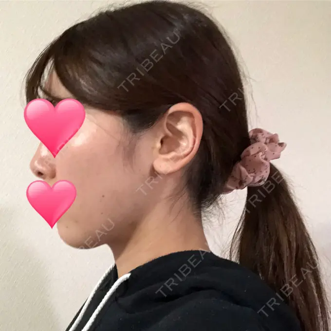 ほくろ・いぼ切除（肌） / バッカルファット除去 / 脂肪吸引（顔） / ヒアルロン酸注入（あご） エートップ美容整形外科 DAY 76 メイン用