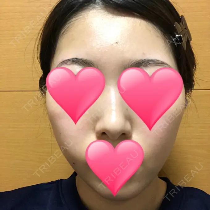 ほくろ・いぼ切除（肌） / バッカルファット除去 / 脂肪吸引（顔） / ヒアルロン酸注入（あご） エートップ美容整形外科 AFTER メイン用