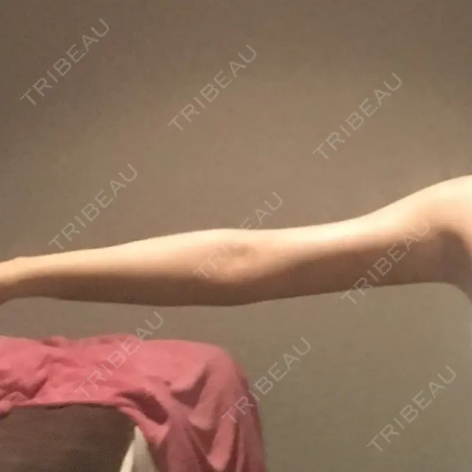 脂肪吸引（二の腕） / インディバ（お腹） ヨンセスリムライン AFTER メイン用