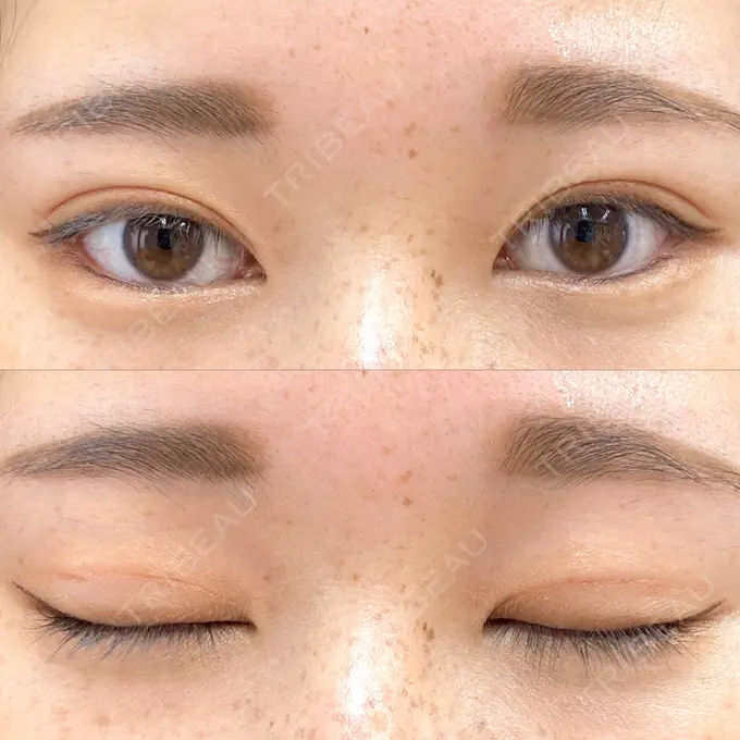 二重埋没 フェアクリニック川口 DAY 37 メイン用