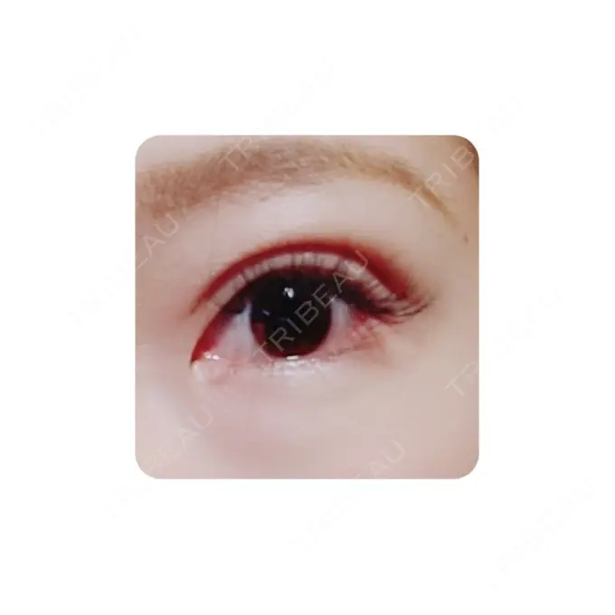 二重切開 カリスクリニック DAY 34 メイン用